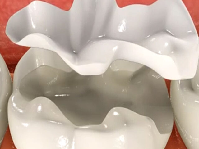 https://arlingtondentalarts.com/wp-content/uploads/2023/01/dental-onlay-640x480.jpeg