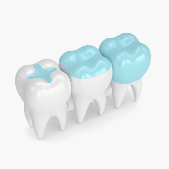 https://arlingtondentalarts.com/wp-content/uploads/2023/04/dental-sealants-640x640.jpg