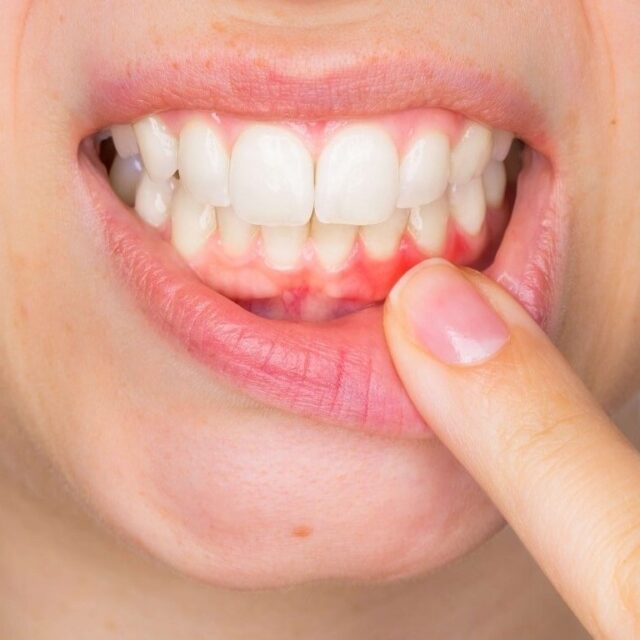 https://arlingtondentalarts.com/wp-content/uploads/2023/04/gum-disease-treatment-640x640.jpeg